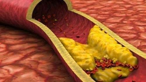 胆固醇|体内血脂超标，身体3处或“知道”，早知早预防