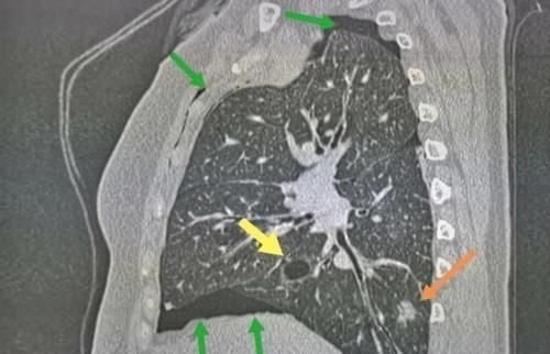 肺结节|癌症病人的幸运指数不一样,这位老太太想感谢一个吹破的肺大泡