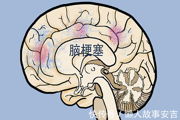营养物质|轻度脑梗的信号是什么?身体的“求救信号”别忽视,趁早就医