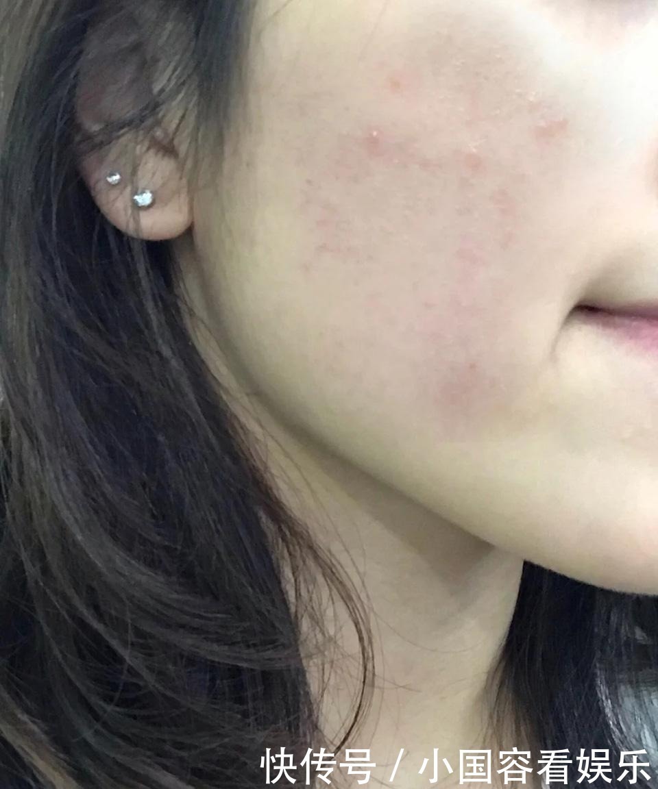 做到这3点,和痘痘肌说再见,让你素颜也很美