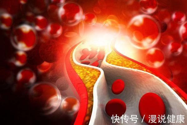 坏习惯|心血管疾病“祸根”不只是烟酒!5个坏习惯若你也有,早检查血管