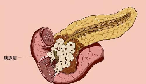 患者|医生坦言:最不希望患者碰到3种癌,发作前毫无征兆,要早作预防