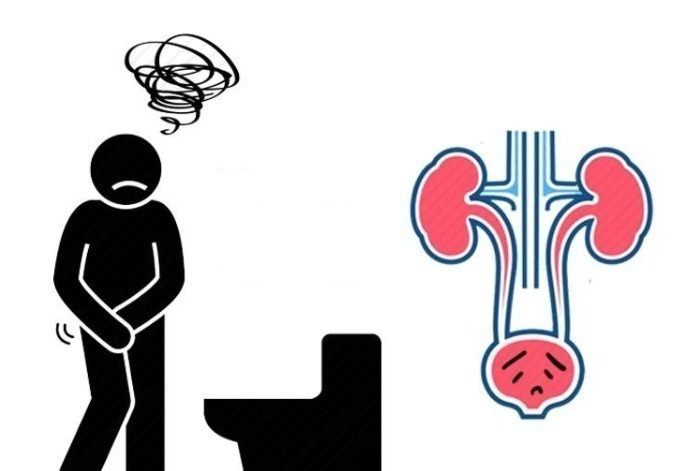 膀胱癌|小便时若出现4种表现,要当心,这或是膀胱癌已靠近的信号!