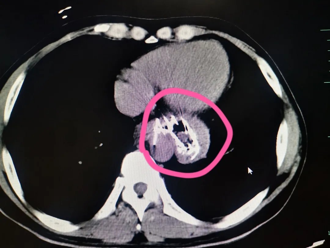 吞咽困难|38岁男子胃里遍布“钢针”，竟是20多年前的支架
