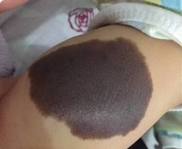 宝宝|宝宝的胎记怎么来的?产科医生:孕期这2种行为易长胎记,要避开