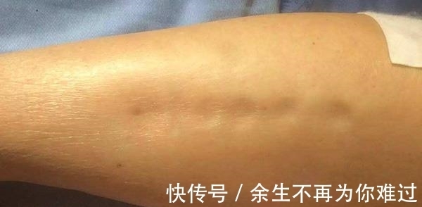 现象|肝硬化来袭之前，身体或会释放一些求助信号，可惜很多人视而不见