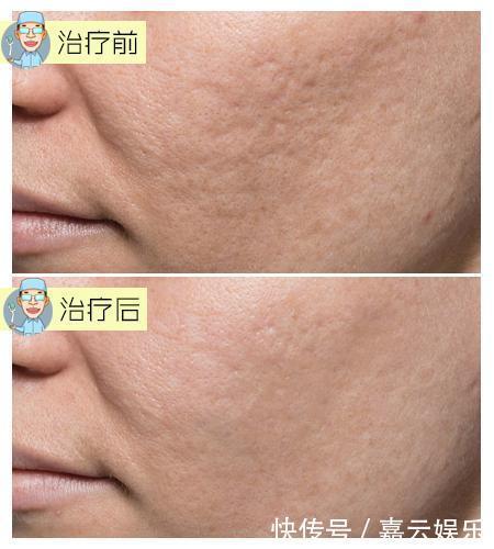 收敛毛孔，除了光子嫩肤，这两种方法也很出色