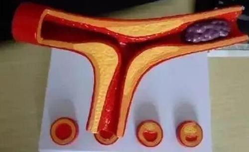  不明原因|如何得知身体有没有血栓, 医生给出5个自测标准, 看看你有吗!