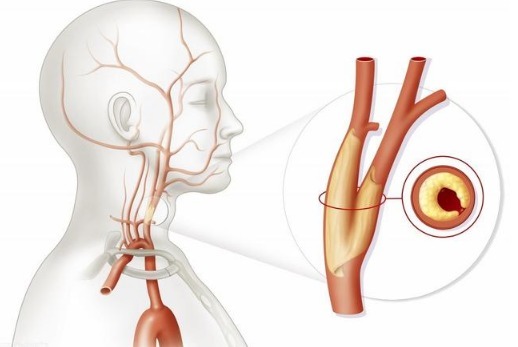 动脉血管|3个人就有1个颈动脉斑块!如何预防和治疗医生说的清清楚楚