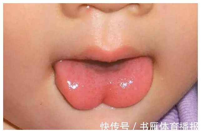 舌苔|苹果水能缓解小儿积食?医生建议:要想脾胃好,这2物要少吃