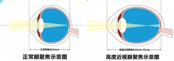 高度近视|泰安一女子差点因近视导致失明！就因为这个病…..