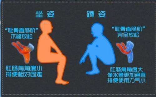 姿势|便秘和大便姿势有关系?换个姿势大便更畅通