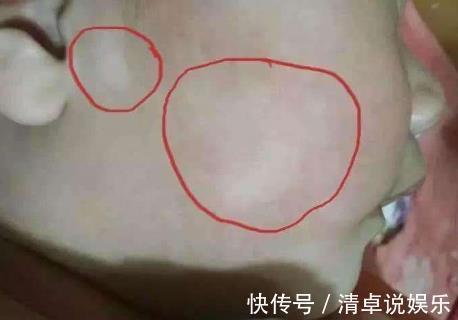 驱虫|5个症状可能是“蛔虫病”的表现,驱虫迫在眉睫,家长要留意