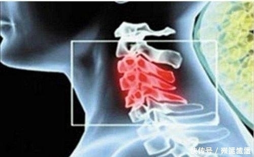 酸疼|颈椎安康：得了颈椎病不要怕，四个防护方法助您保护您的颈椎