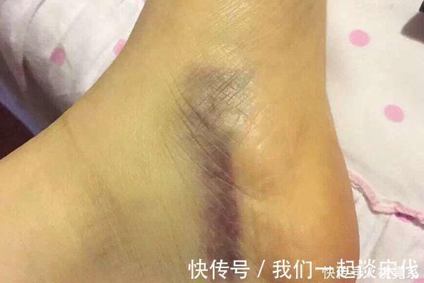 皮下出血|肺癌早期,总是不痛不痒提醒皮肤有“突变”,及时做检查