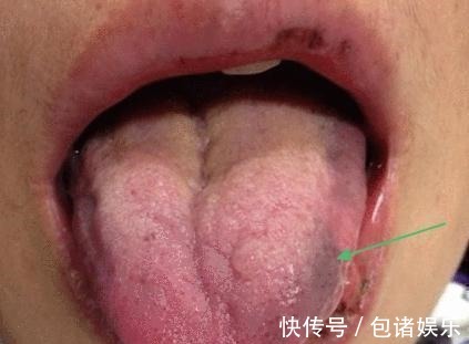 癌症|身体里有肿瘤,舌头上也会有表现!出现3种异象需小心