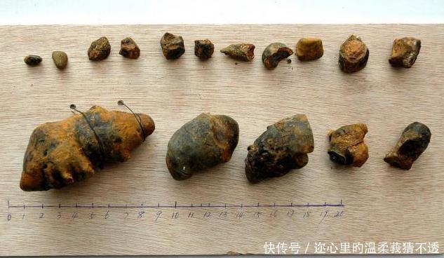 原因|膽結(jié)石和腎結(jié)石形成原因找到了這些不良飲食習(xí)慣你中招了嗎