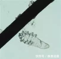 被褥|女子睫毛里长了100多只虫子! 有这个习惯的要当心了