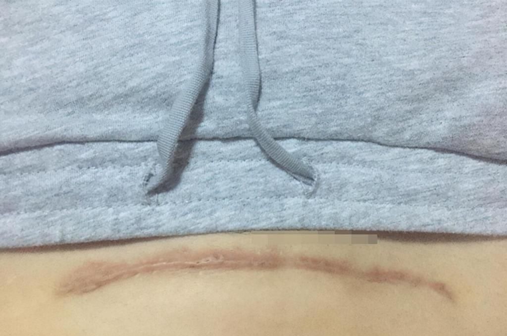 产科医生|剖腹产选择“横切”还是“竖切”?别轻视这一刀,两者效果大不同