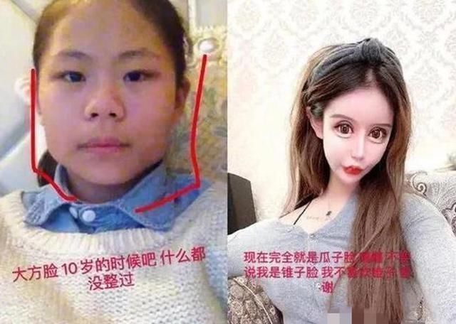 小姑娘|13岁女孩“沉迷整容”，3年整60多次，如今五官留下这么多后遗症