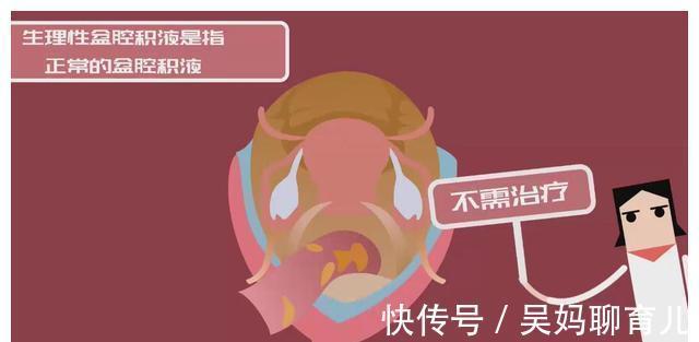 宫颈|提醒广大女性:一般情况下,3种“妇科病”不用治,别自己吓自己