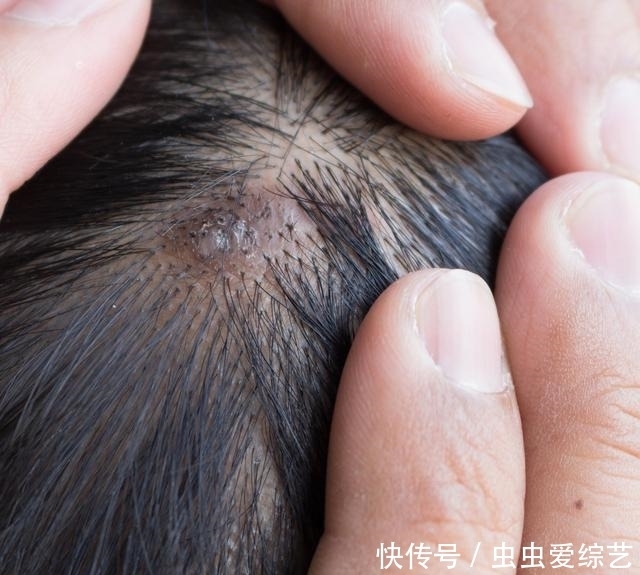 天呐!螨虫居然能在头上搞出那么多事,你是不是也中招了?