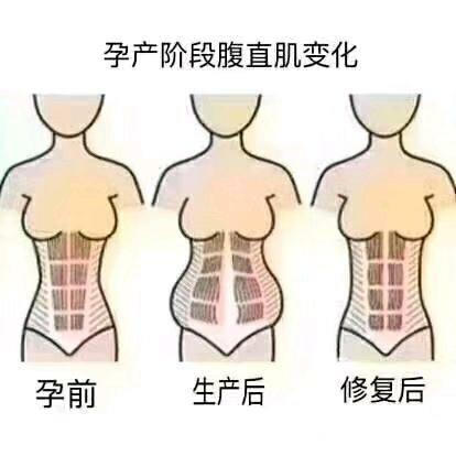 什么是腹直肌分离宝妈们如何修复腹直肌分离而拒做小腹婆呢
