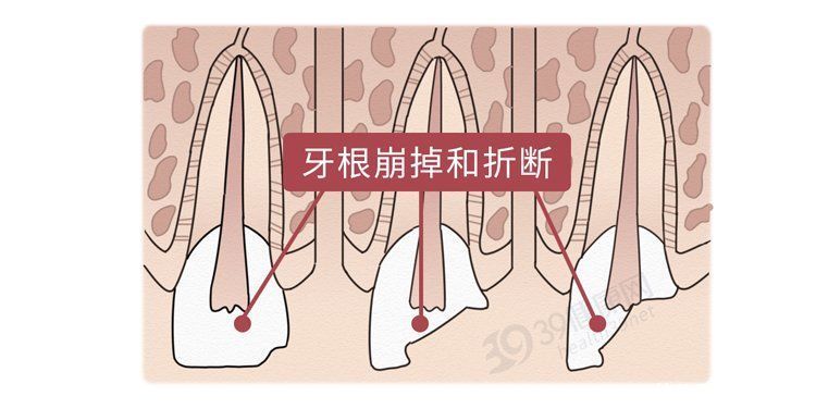 磨牙症|为什么有人总是睡觉磨牙?肚子里真的有蛔虫?科学的解释来了