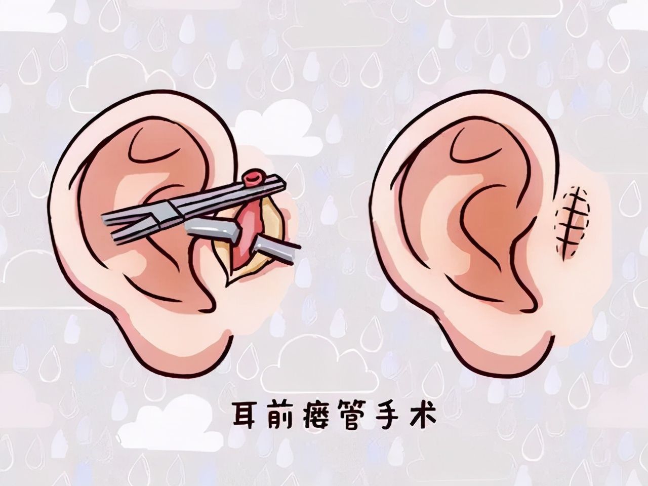 柴亮|聽說耳朵長“聰明孔”，大富大貴還聰明？現實是，10歲女孩因它挨了刀