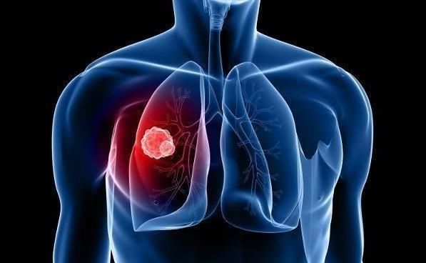 肩部|身体的两个部位持续疼痛,不要粗心大意,可能是肺癌的早期信号!