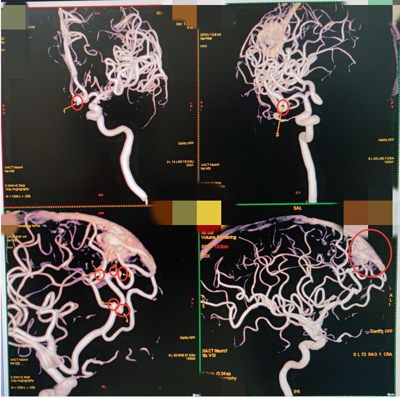 张大叔|女子洗澡后突然剧烈头痛，竟查出7个动脉瘤！医生：冬季千万注意