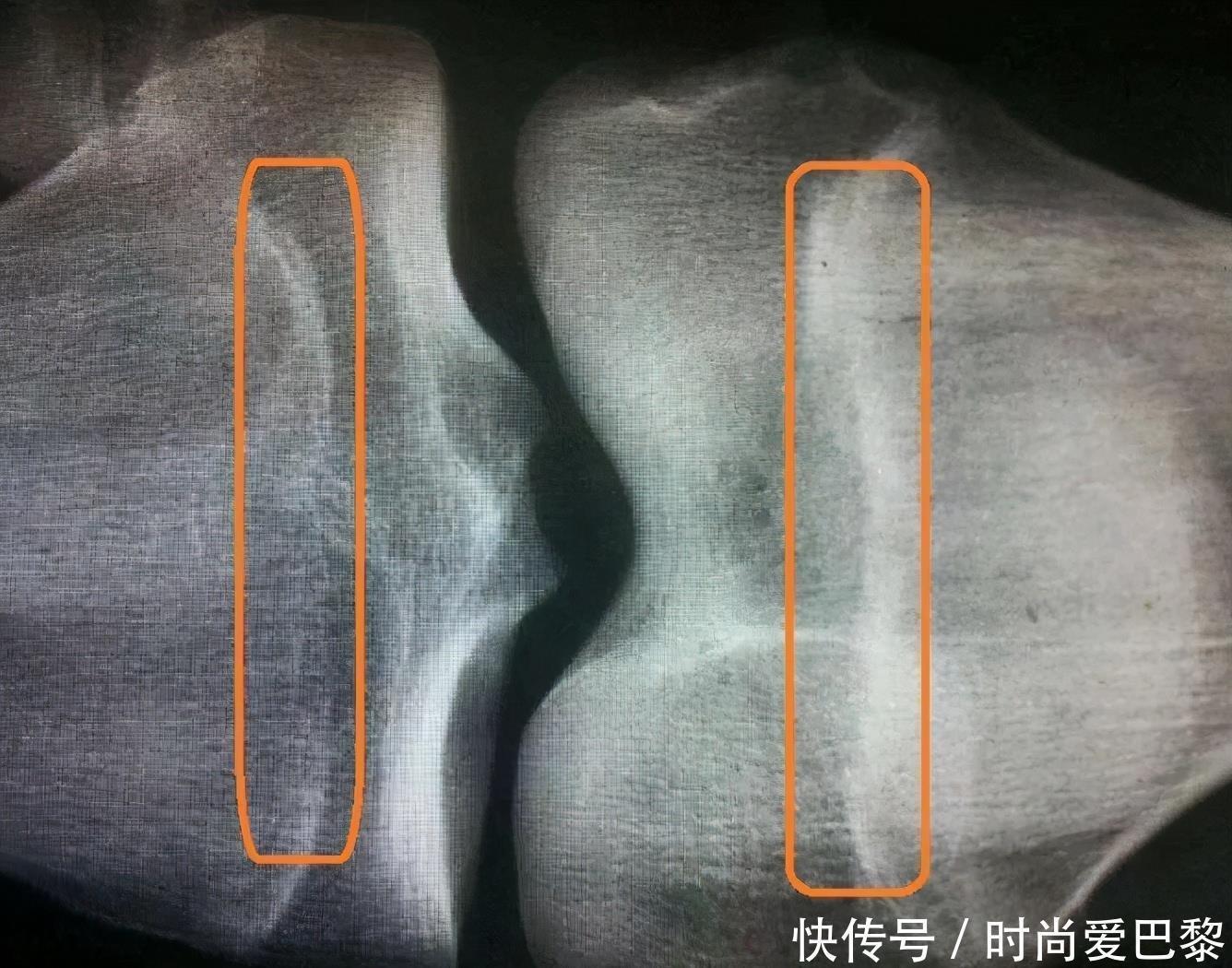 身体|孩子骨骺线闭合前，身体会给出3处“提示”，若忽视，孩子长个难