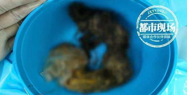 胃镜|头皮发麻14岁女孩胃里塞满这些,这个可怕的习惯她保持了十年