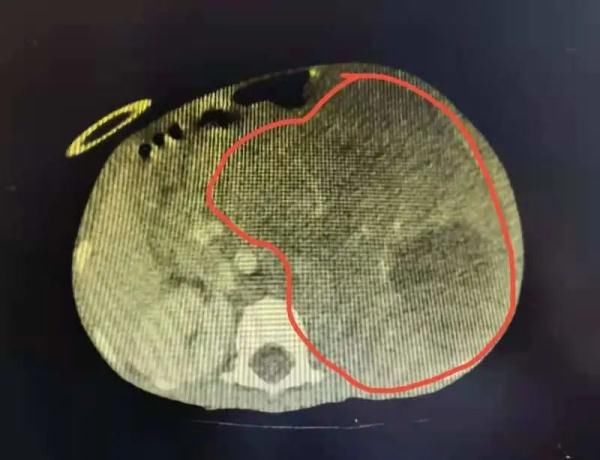 3岁女孩只有10公斤，肿瘤充满腹腔