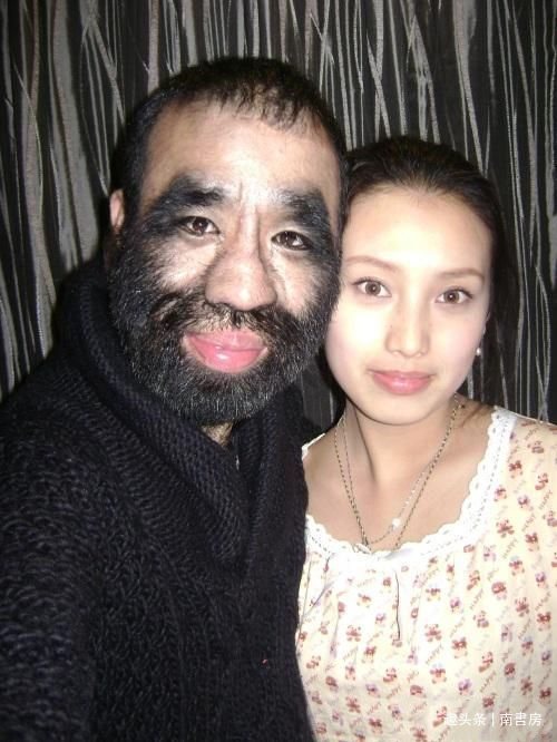 中国毛孩于震寰,曾因毛发过多而自卑,