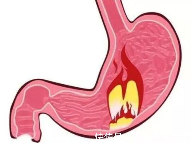 癌症|从“炎症”到“癌症”需要多久?提醒:3种炎症建议尽早治疗