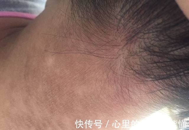 发黑|9岁小女孩脖颈发黑洗不掉,经医院检查后,医生的话却让家长笑了