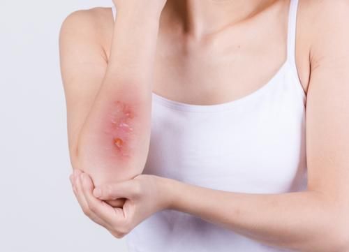 艾滋病|通过“性生活”传播的疾病有哪些？常见的或有这5种，别太开放了