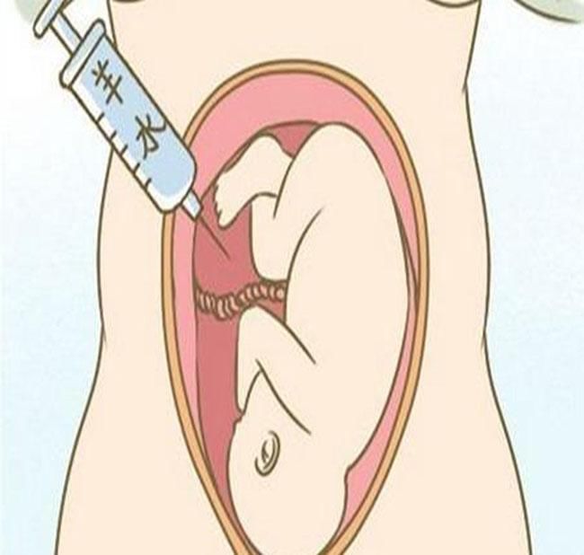 二胎|二胎宝宝35周了,一定要做无创或羊水穿刺吗?听听专家怎么说?