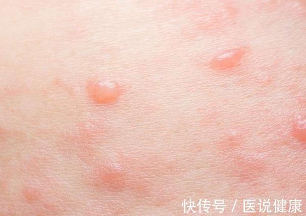 皮肤|皮肤反复出现瘙痒感,要重视,或与这5个因素有关,你需要了解