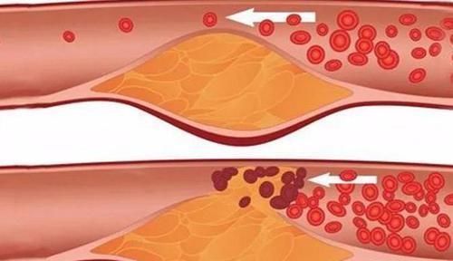 腰间盘突出|中老年人经常腿抽筋,别只知道补钙,做“这件事”才是重中之重