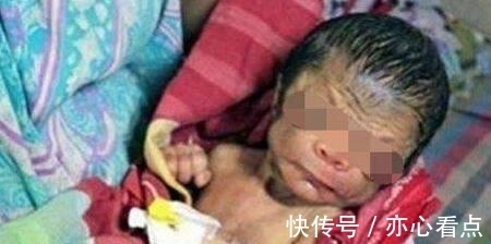 蔡女士|32岁产妇生下”猴子”,小两口崩溃大哭,医生看到宝宝后却笑了
