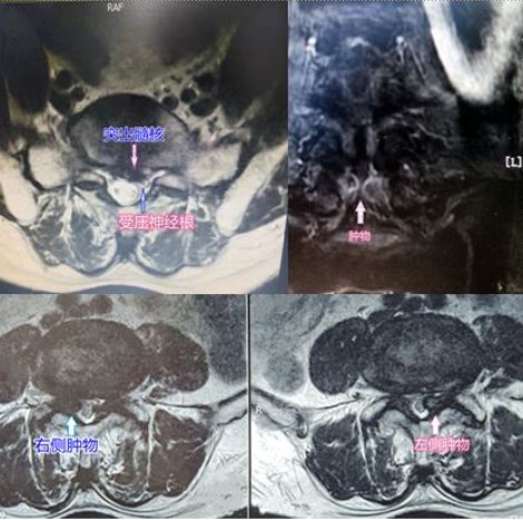 mri|学科?建设丨腰痛伴下肢疼痛，椎间盘突出症？肿瘤？