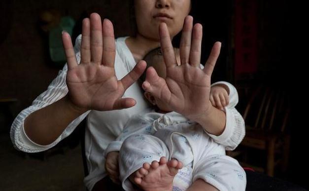 多指症|3个月大的男婴为何长出31根指头？得知原因后母亲崩溃痛哭