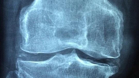 骨质疏松症|天天补钙还得骨质疏松？因为这几件事没做好！