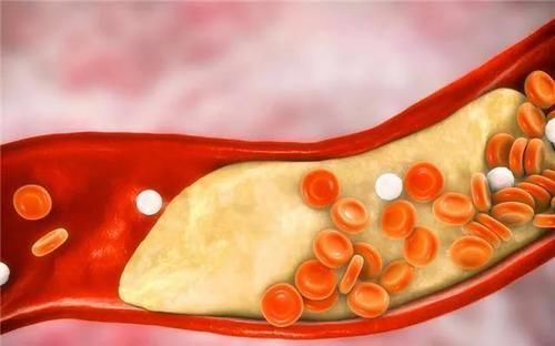 饮食习惯|为了血压健康，这“几种”食物尽量少吃，建议收藏