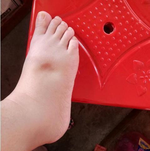 血管|血液粘稠的人,身体两处会发出信号,若没有,说明血管还不算太堵