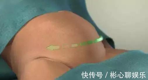 手术|剖腹产到底要挨几刀没你想的那么简单,只有经历过的人才懂