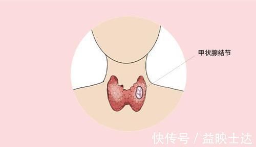 豆制品|有了甲状腺结节,别失落,少吃三种蔬菜,也有恢复可能