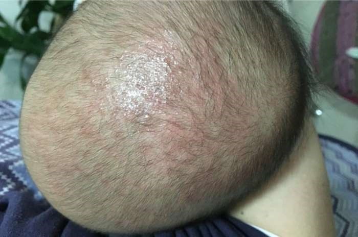 小丽|刚满月的宝宝就高烧不退!医生看到宝宝的头皮后怒斥她不配做妈妈